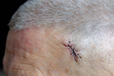 After MOHS Surgery Man after the MOHS Surgery in head