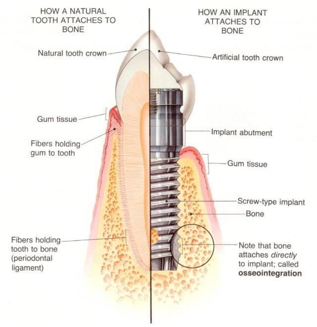 dentalimplants 