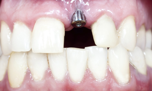 dental implants north kansas city MO