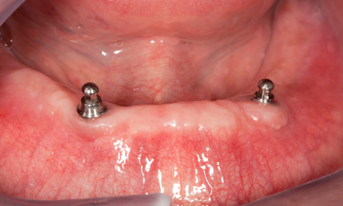 dental implants north kansas city, MO 