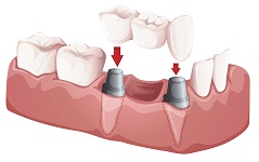 Dental Bridge | Dentist In Elkhart, IN | Elkhart Dental Center