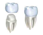 Dental Crowns | Dentist In Elkhart, IN | Elkhart Dental Center