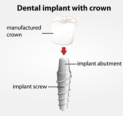 Dental Implants | Dentist In Elkhart, IN | Elkhart Dental Center