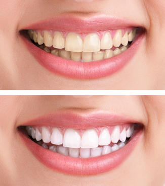 Teeth Whitening | Dentist In Elkhart, IN | Elkhart Dental Center