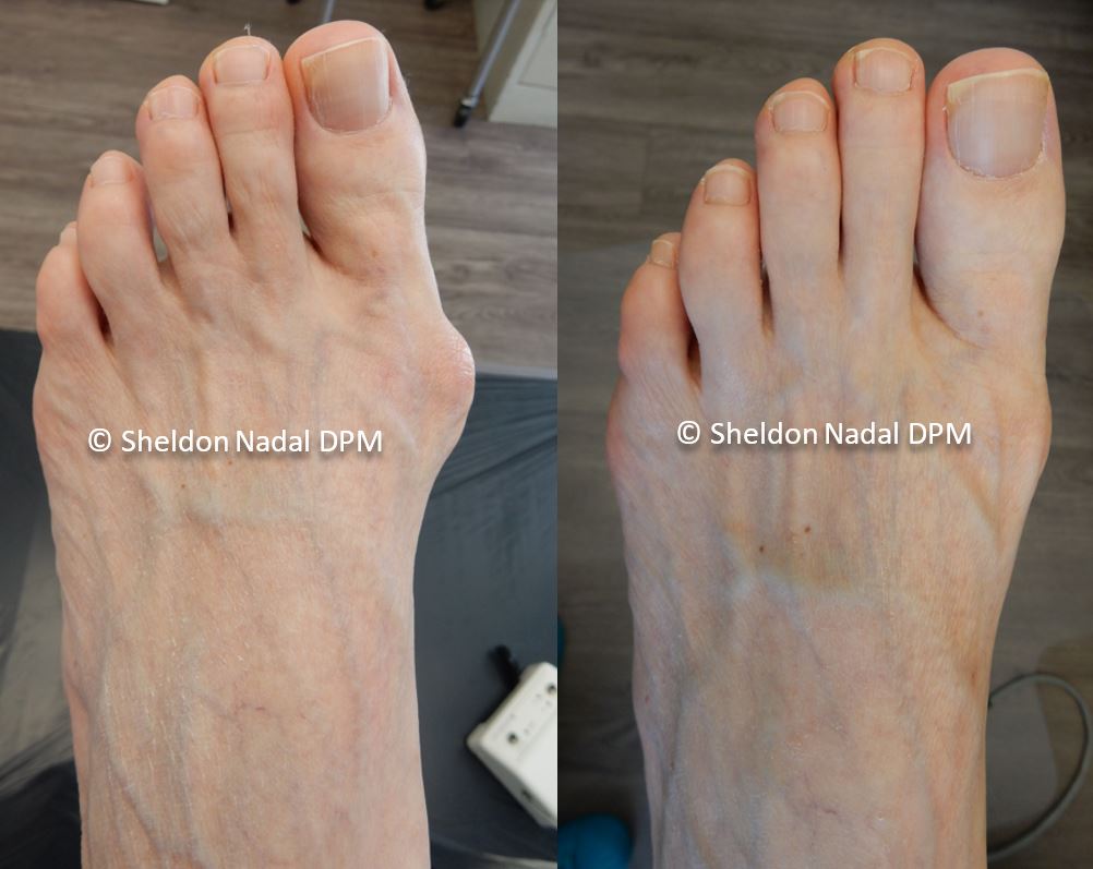 54-year old woman pre-op    1-year post-op left foot.