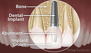 Dental Implants Jacksonville, NC
