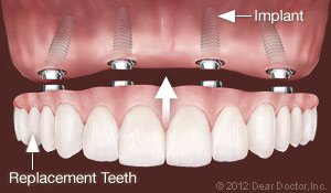 Dental Implants Replace All Teeth Jacksonville, NC