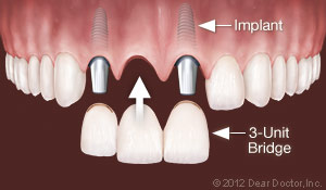 Dental Implants Replace Multiple Teeth Jacksonville, NC