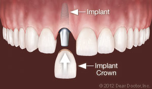 Dental Implants Replace One Tooth Jacksonville, NC