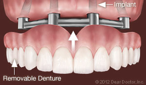 Dental Implants Support Removable Dentures Jacksonville, NC