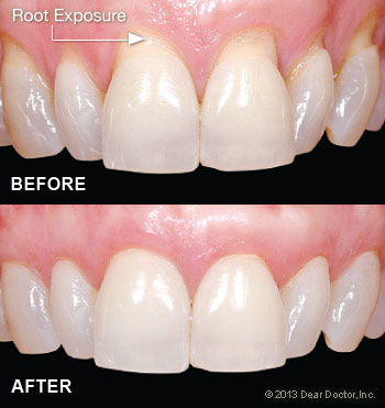 Gum Grafting before and after Jacksonville, NC Dentist