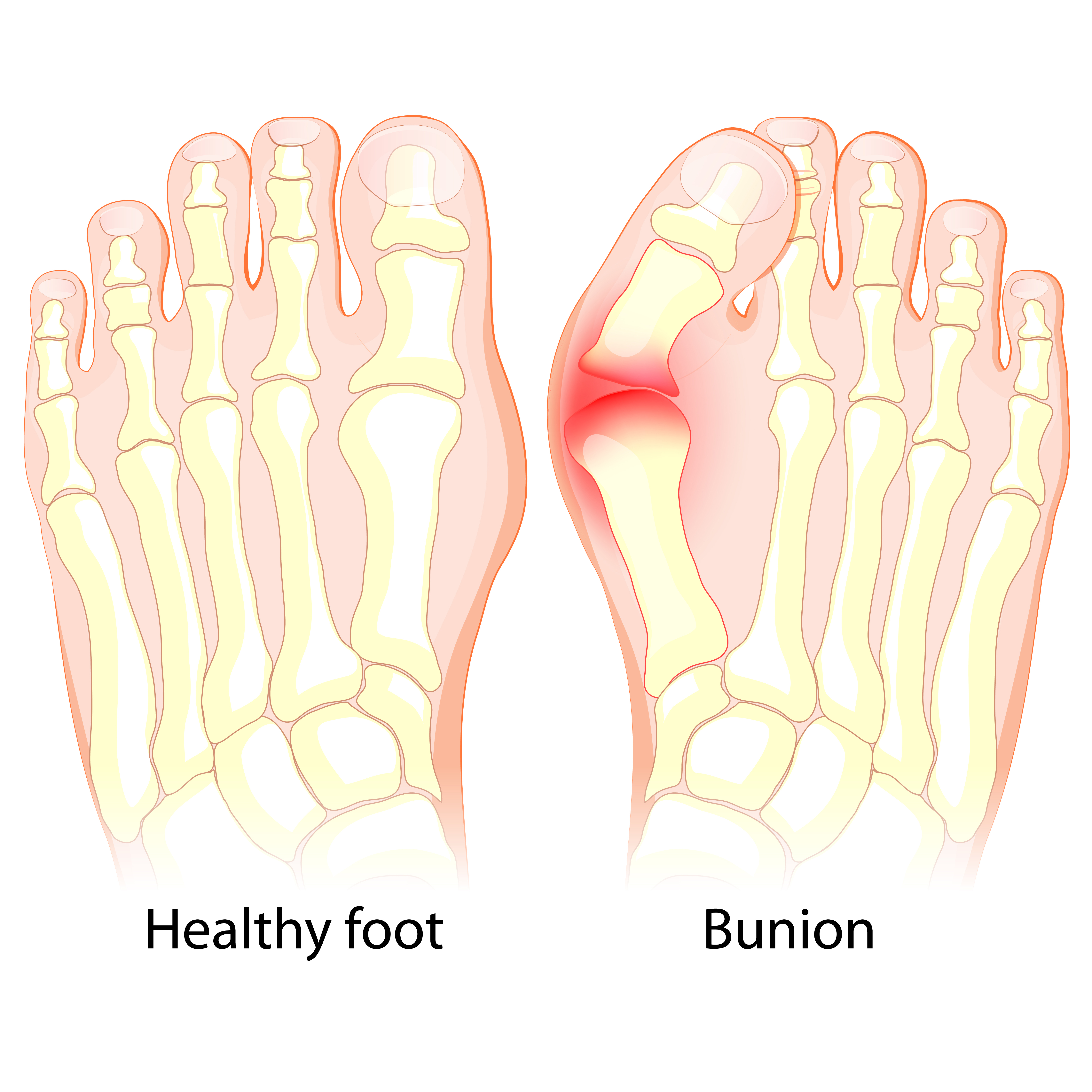 Healthy foot and foot with Bunion