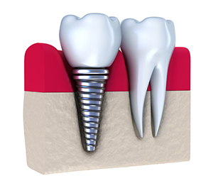 Dental Implants | Dentist In Warren, MI | James J. Karam, DDS