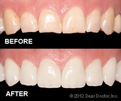 before and after dental veneers San Antonio, TX 