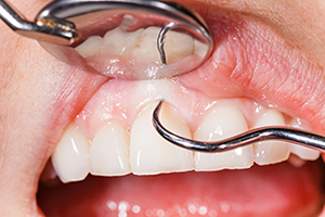 dental tools performing exam on teeth for gum disease, Periodontist San Antonio, TX 