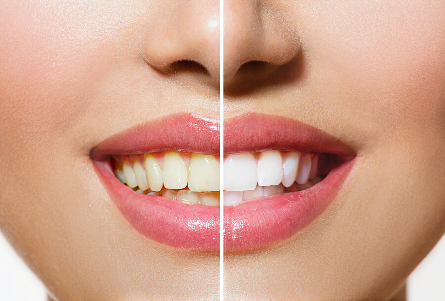 before and after results of teeth whitening, dentist San Antonio, TX