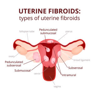 uterine fibroid embolization in philadelphia pa