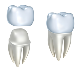 illustration of crown being fitted over tooth, dental crowns University City, MO dentist