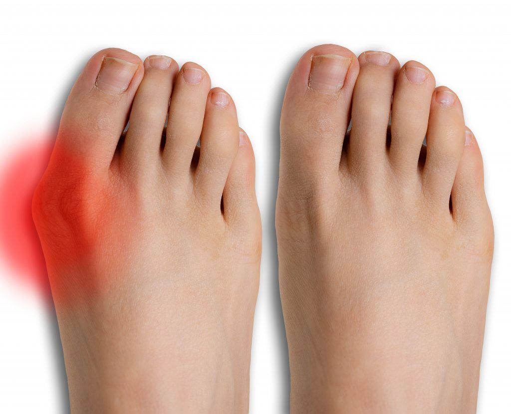 bunion pain in  Winter Haven, Lakeland, & Davenport, FL