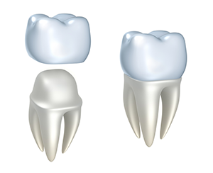 illustration of dental crown assembly, Port Orchard, WA crowns and bridges