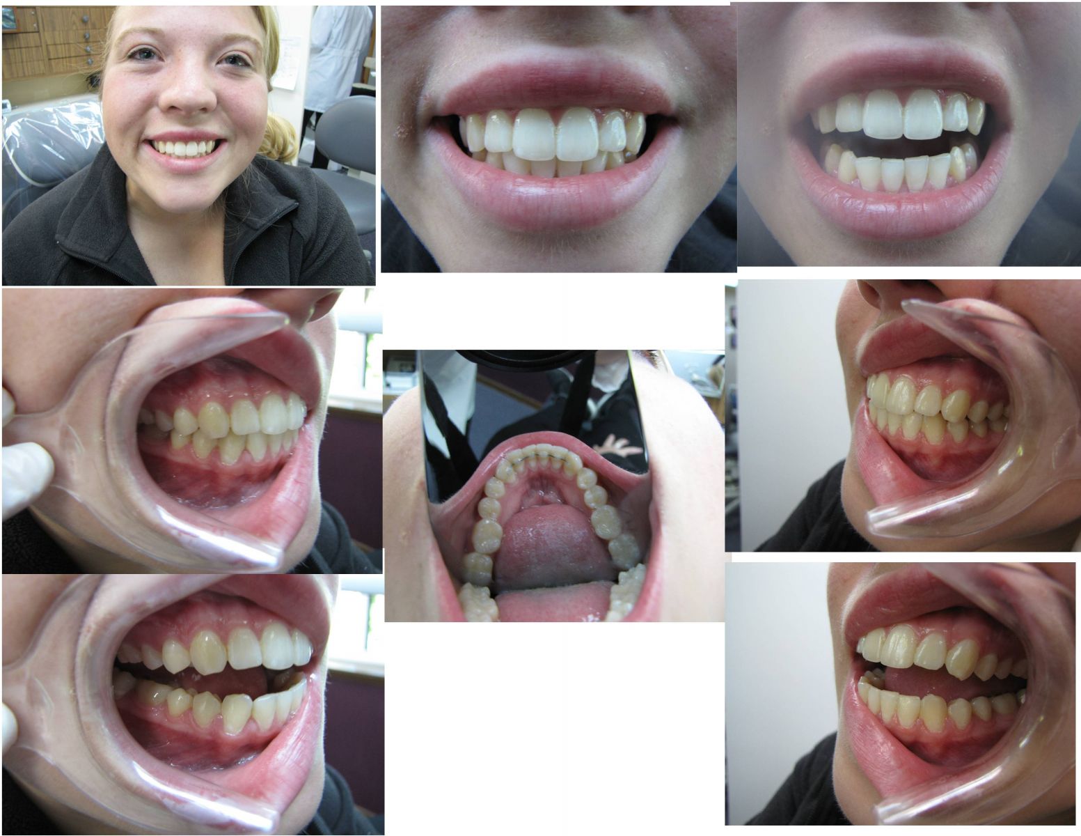 Cosmetic Orthodontics in Port Orchard, WA - After Treatment