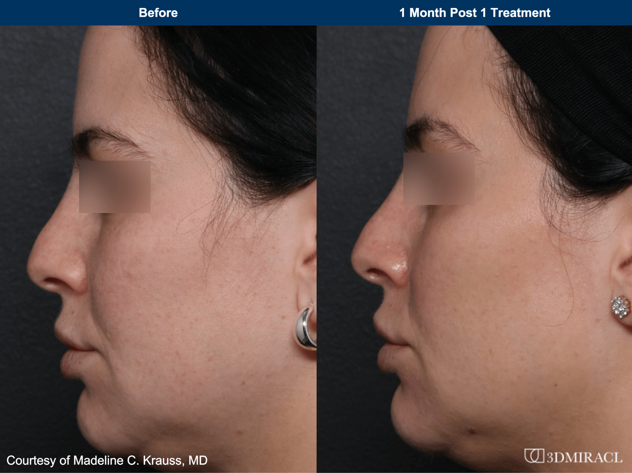 UltraClear before and after photos