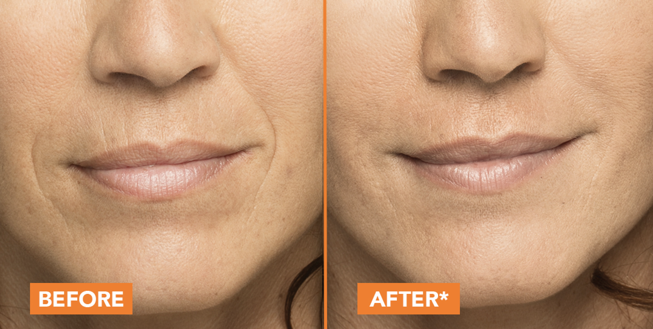 Atlas Dermatology Belotero Balance PLUS before and after.