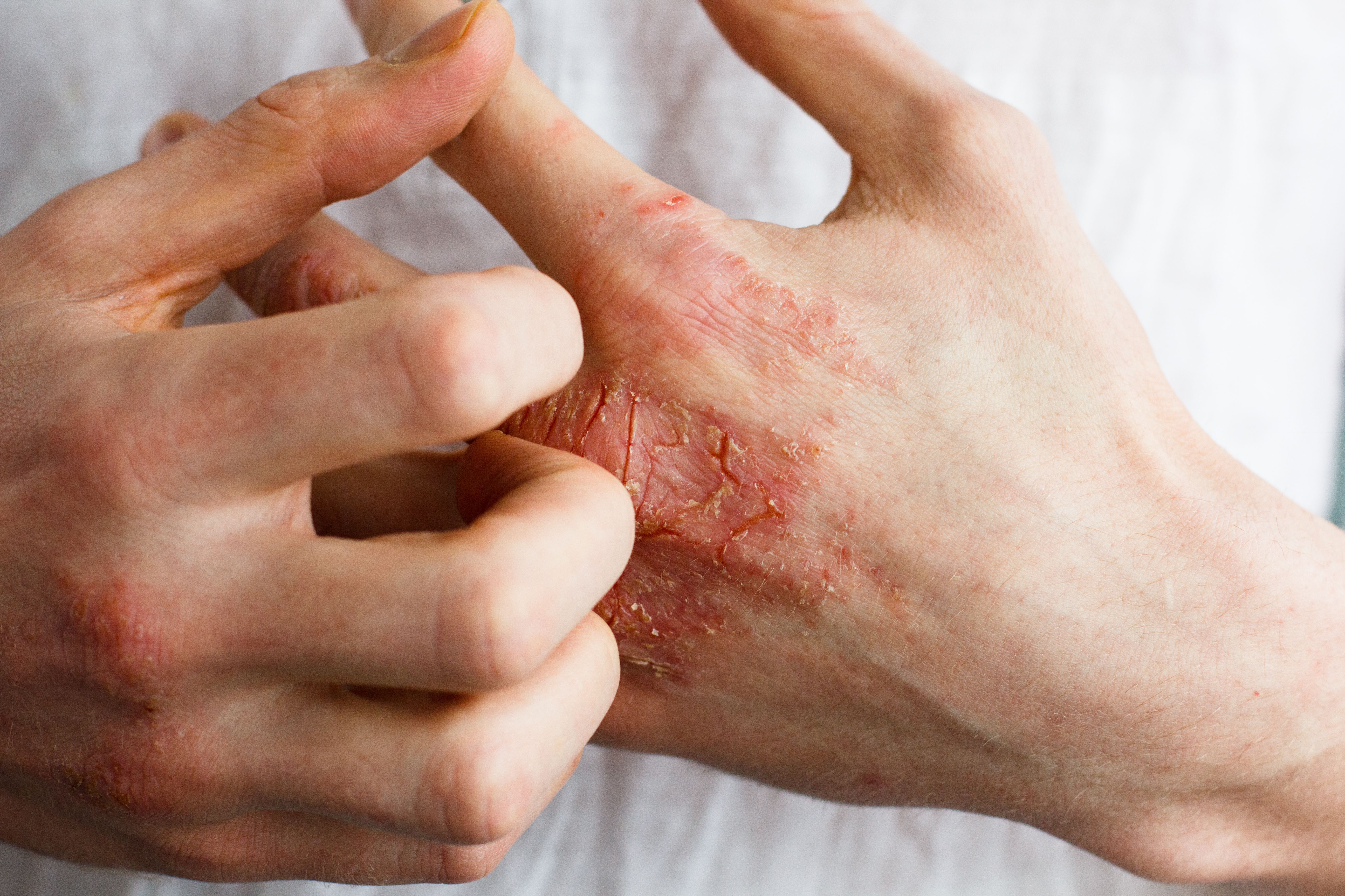 Hand Dermatitis