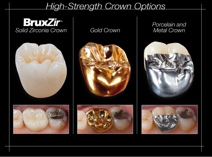 1st Qtr 2012 Newsletter - High strength crown options