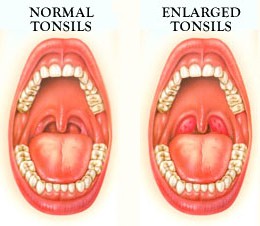 Enlarged-Tonsils-in-Children