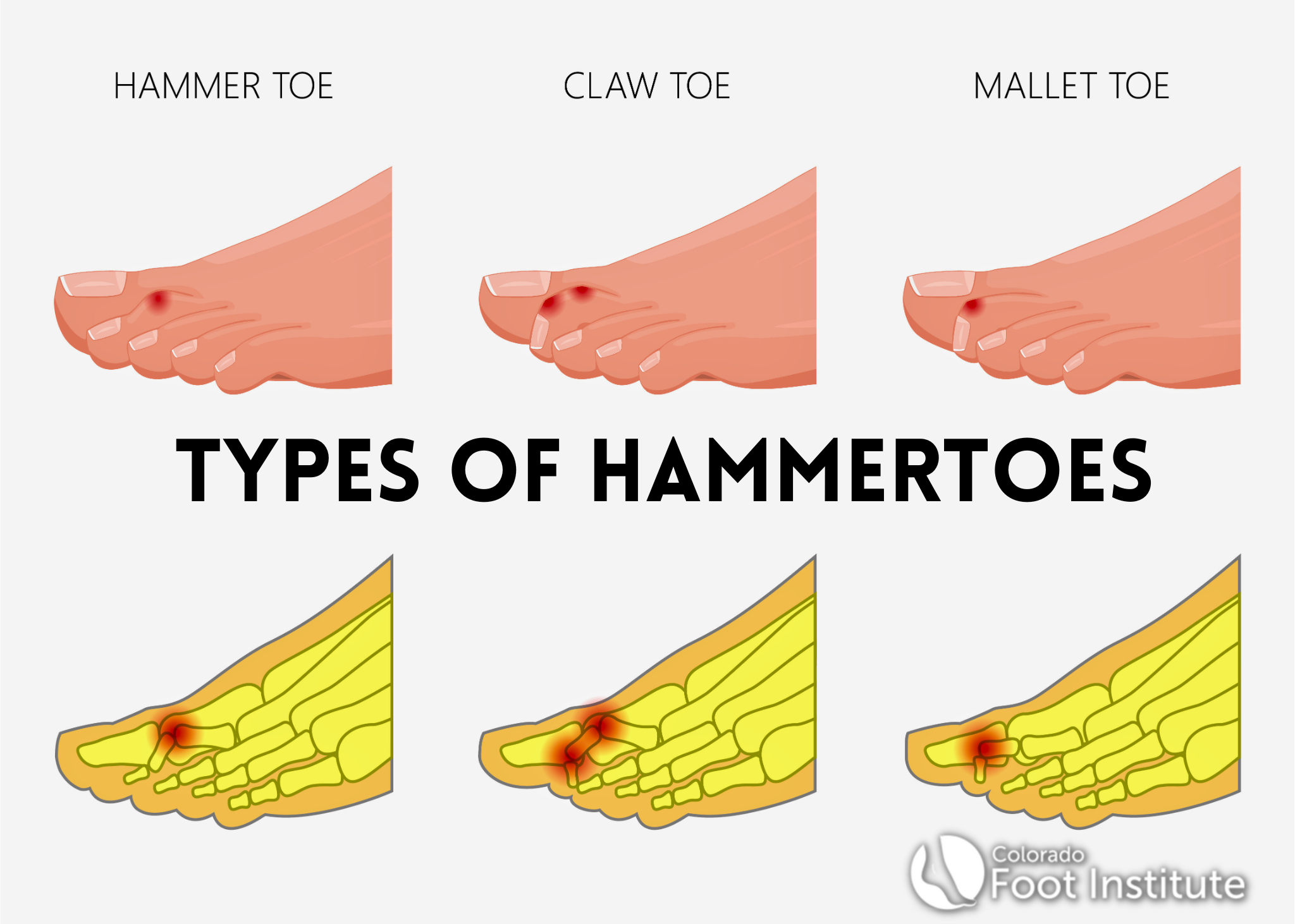 Hammertoe images