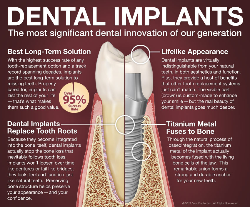 Dental Implants Maspeth, NY Dentist