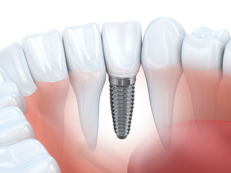 illustration of natural teeth in gums next to embedded implant, Fairfax, VA dental implants South Riding, VA dentist