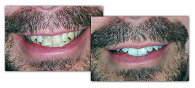 before and after teeth whitening, Grand Rapids