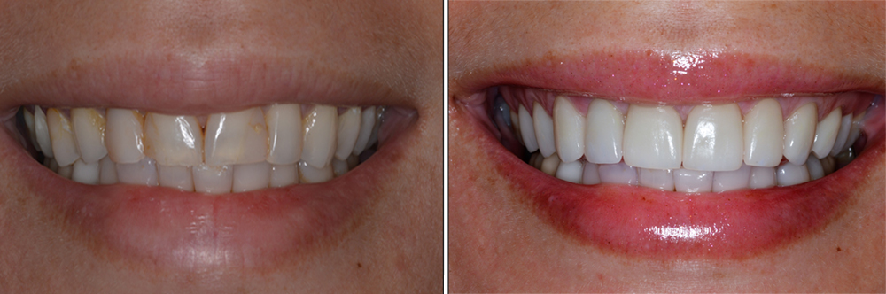 Before and After Sunshine Dentistry