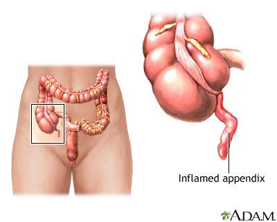 abdominal pain