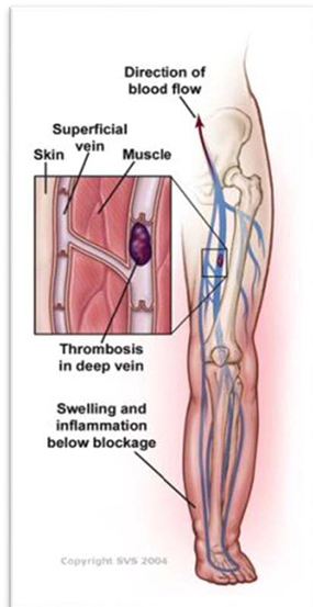 blockage_swelling