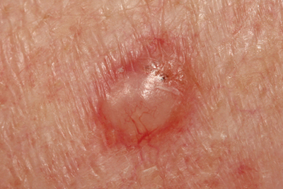 Basal-Cell-Carcinoma-Treatment-in-Bend-OR