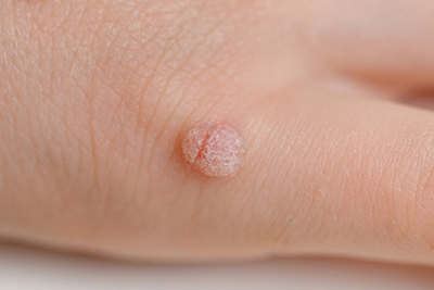 Warts-Treatment-in-Bend-OR