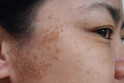 Dark-Spots-Treatment-in-Bend-OR