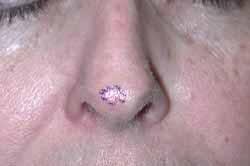 Small basal cell carcinoma nasal tip