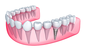 illustration of lower gums with teeth and dental implant assembly West Bloomfield, MI
