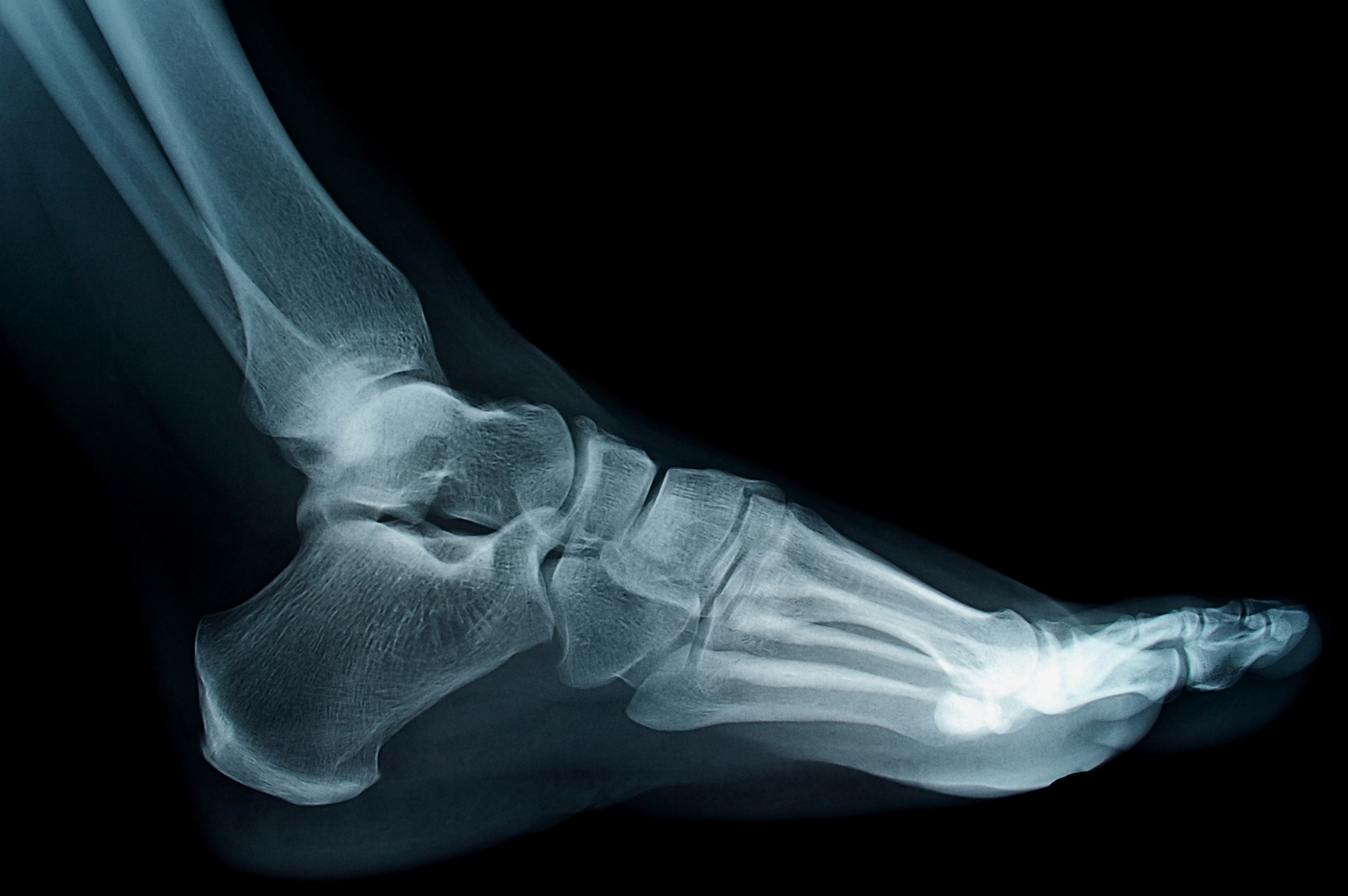 Foot and Ankle X-Ray west houston tx