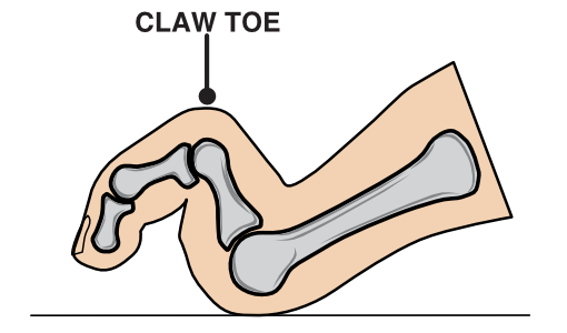 clawtoe