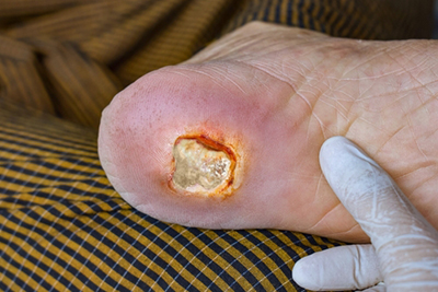 Detailed view of a heel showing an arterial ulcer.