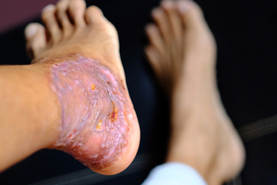 Foot two weeks after a skin graft procedure