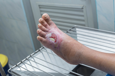 Close-up of a diabetic foot ulcer on the left foot