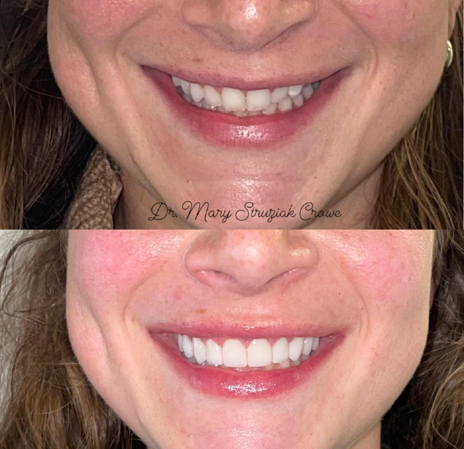 Photograph of woman after Cosmetic Dentistry, Chicago Loop, IL