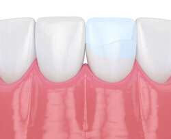 illustration of teeth in gums, one with bonding repairing cracked tooth, cosmetic dentist Washington, DC cosmetic dentistry