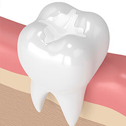 illustration of tooth with cosmetic tooth-colored filling in it, cosmetic dentistry Washington, DC cosmetic dentist